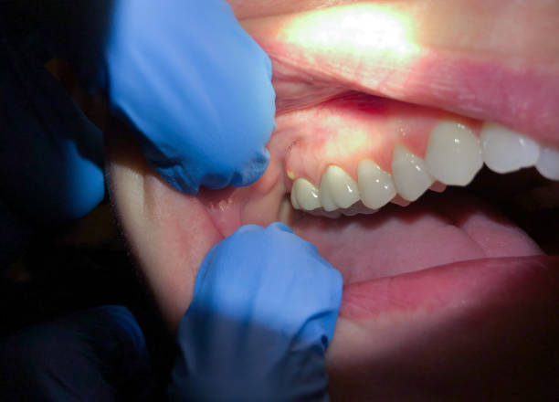 Emergency Dental Filling Replacement in NC
